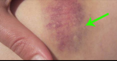 Do Your Bruises Look Like THIS? I Had No Idea It Meant This About My Blood!