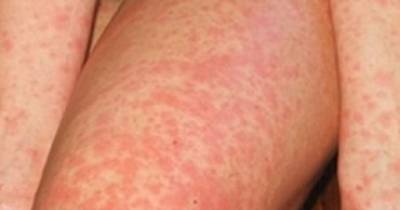 A Deadly New Virus Is Spreading Fast. What It Can Do To Your Baby Is Terrifying