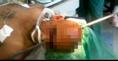When Doctors See The Spike Through This Man's Head, They Never Expected Him To Say This..