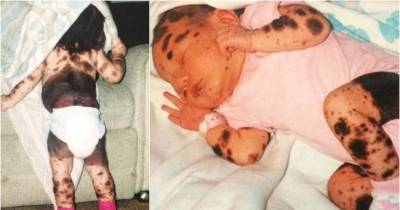 Their Newborn Was Covered With Hundreds Of These, But Look At Her 19 Years Later....