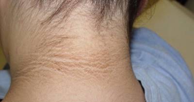 This Dark Ring Around The Neck Could Mean Your Health Is At Risk
