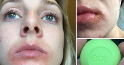 Women Say They Have Blisters And Rashes After Using EOS Lip Balm