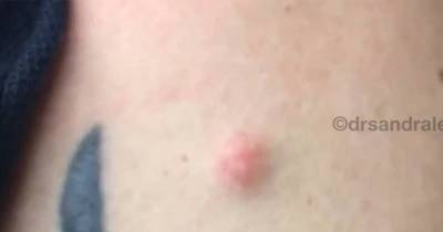 Watching This Cyst Removal Is Like Watching An Alien Give Birth