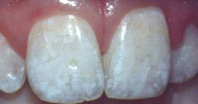 White Spots On The Teeth Need To Be Taken Seriously And Here&rsquo;s Why