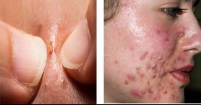 The Science Behind Why Videos Of Popping Pimples, Cysts, And Blackheads Are So Popular Right Now