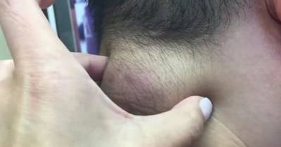 Man Horrified By What Bursts Out Of Golf Ball-Sized Lump Under His Skin