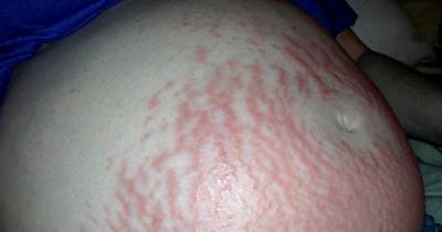 Mom-To-Be Learns That Her Itchy Stretch Marks Are A Pregnancy ALLERGY