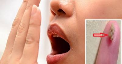 She Had Horrible Breath And Didn't Know Why. Then She Found THESE In Her Throat!
