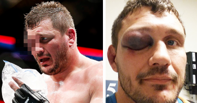 UFC Fighters Eye Injury Is One Of The Worst You Will Ever See