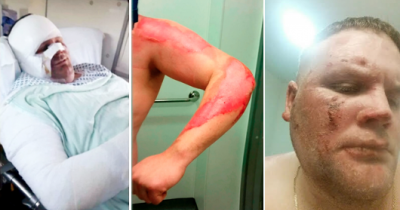 Man Hospitalized After E-Cigarette Explodes In His Face