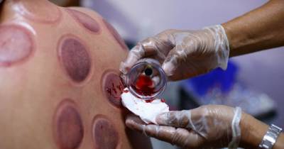 Cupping Therapy Is The New Cure For Your Health