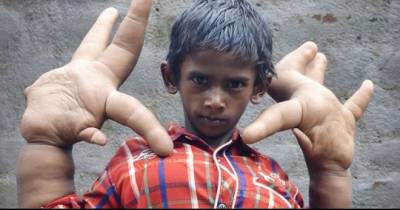 &lsquo;Boy With The World&rsquo;s Biggest Hands&rsquo; To Have Life-Changing Operation