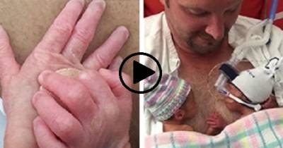 Preemie Twins Can't Stop Holding Hands After Birth