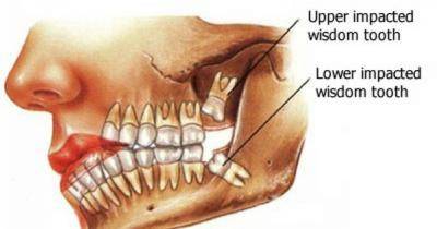 This Is Why You Should Not Extract Your Wisdom Teeth