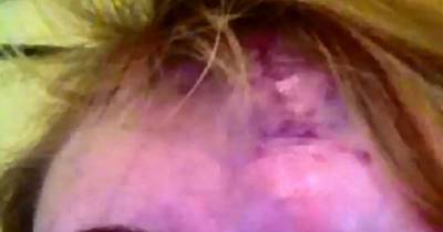 Horror As Mum Finds Three Tumours Under Birthmark On Forehead After It Burst During Childbirth