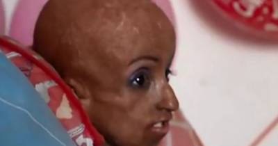 35 Year Old Mother Is Raising Her Daughter Who Has Aged 90 Years In Only 15. Doctors Are Calling Her Survival A Medical Miracle!