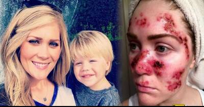 Skin Cancer Patient Shows The Horror Of Tanning Through Graphic Selfies