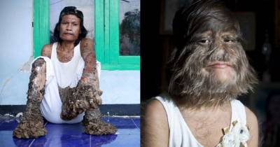 8 Fascinatingly Rare Disorders