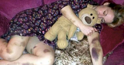 The Reason This Woman Woke Up With Bruises Covering Her Body Is Terrifying!
