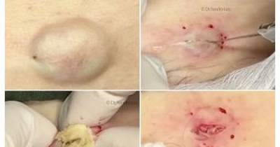 Intense Video Shows 'Dr Pimple Popper' Squeezing Huge Cyst On Woman's Stomach