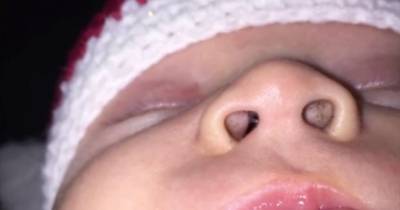 Mom Noticed Black Dots In Her Baby&rsquo;s Nose. Little Did She Know A Common Household Item Was To Blame