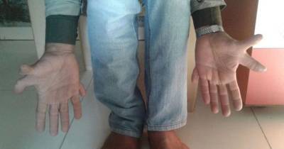 Carpenter With Record-Breaking 28 Fingers And Toes Is Scared He Might Accidentally Chop Them Off