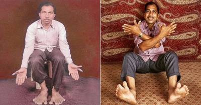 Man Has Record Breaking 28 Fingers And Toes