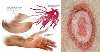 Beware: Ringworm Can Attack These Parts Of Your Body