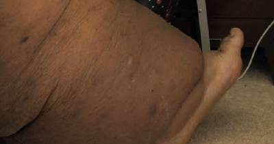 Woman Suffered A Personal Tragedy And Gained 500 Pounds Weight After Losing Control Of Her Eating Habits
