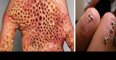 Trypophobia Is A Real, Terrifying Thing, And You Definitely Have It