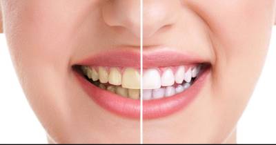 Dentists Are Trying To Hide This Mom's Trick To Whiter Teeth For Just $3!