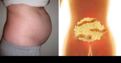 This Is Why You Have Bloated Stomach And How To Get Rid Of Bloating And Lose Weight Overnight!