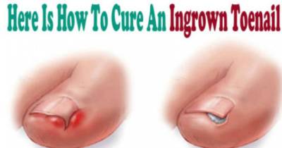 Here's How To Get Rid Of Ingrown Toenail Without Surgery