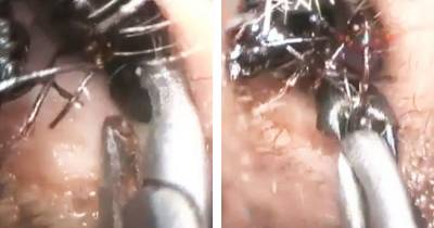 Young Girl Gets Ant Nest Removed From Her Ear