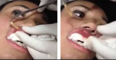 They Think Her Lip Is Swollen Until They Find A Larvae Inside!