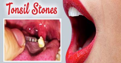 If You Have Bad Breath You May Have Tonsil Stones