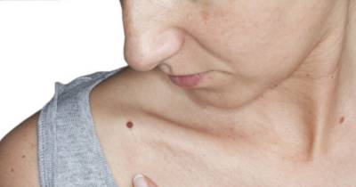 If You Have A Mole At One Of These 7 Places On Your Body This Is What It Says About Your Personality