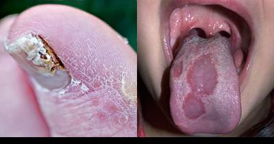 These Fungi Are Making You Sick And You Probably Don't Even Realize It