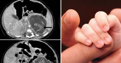 Medical Mysteries: Chinese Baby Born 'Pregnant' With Twins
