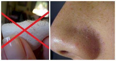 This Is Probably The Easiest Trick To Remove Blackheads And Give Your Face The "Glow" You'll Ever See
