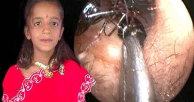 Little Girl Has One Thousand Ants Removed From Her Ears