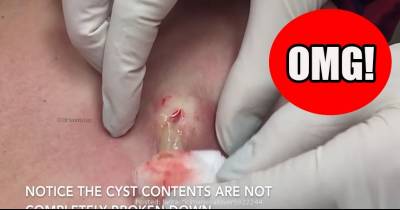 The Grossest But Most Satisfying Cyst Popping Ever