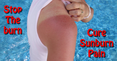 The Easiest Way To Get Rid Of A Sunburn