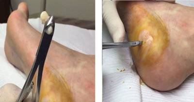 Insane Moment A Man Has A Giant Cluster Of WARTS Sliced Out Of His Foot