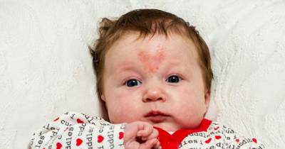 Baby Girl Conceived On Valentine's Day Is Born With A HEART-Shaped Birthmark In The Middle Of Her Forehead