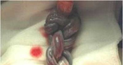 Mom Expected Normal Twins, But When the Doctors See This, She's SHOCKED