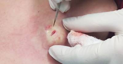 Explosive Cyst Gets Popped Then Won&rsquo;t Stop Oozing