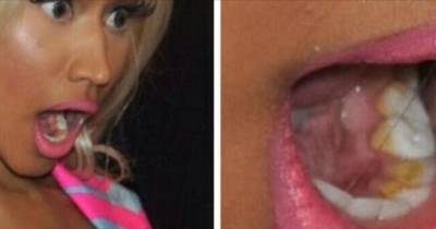 Celebrities Who Stay Too Dirty, Nicki Minaj Doesn't Even Brush Her Teeth