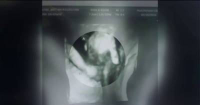 Sonogram Shows Dying Twin Holding Unborn Sister&rsquo;s Hand