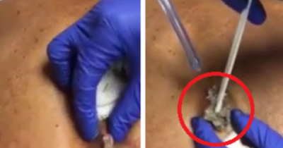 Gruesome Footage Shows Giant Cyst On Man's Back Getting Drained